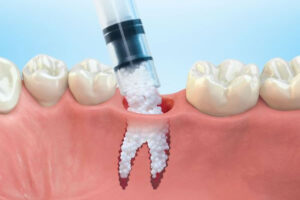 Bone Graft