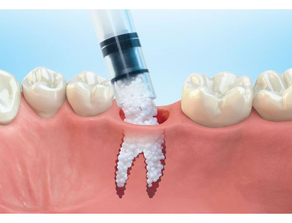 Bone Graft