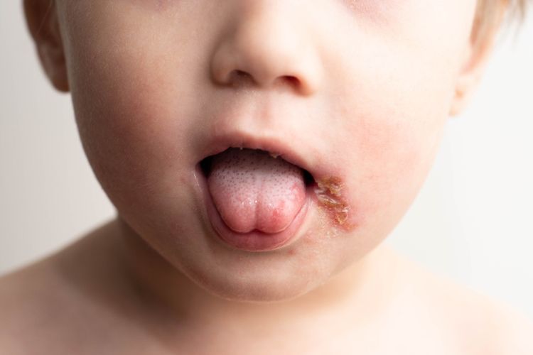 Cara Mengobati Herpes pada Anak