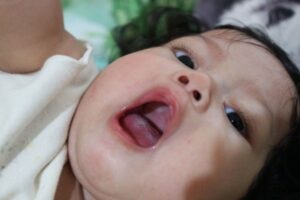 Obat Jamur Mulut Bayi yang Aman dan Efektif